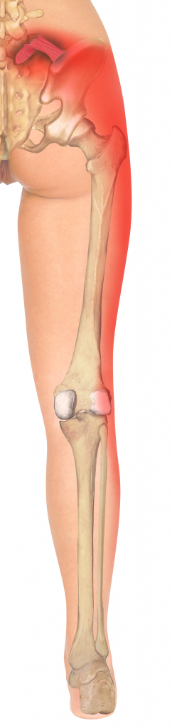 Iliolumbar Ligament Pain Referral Pattern